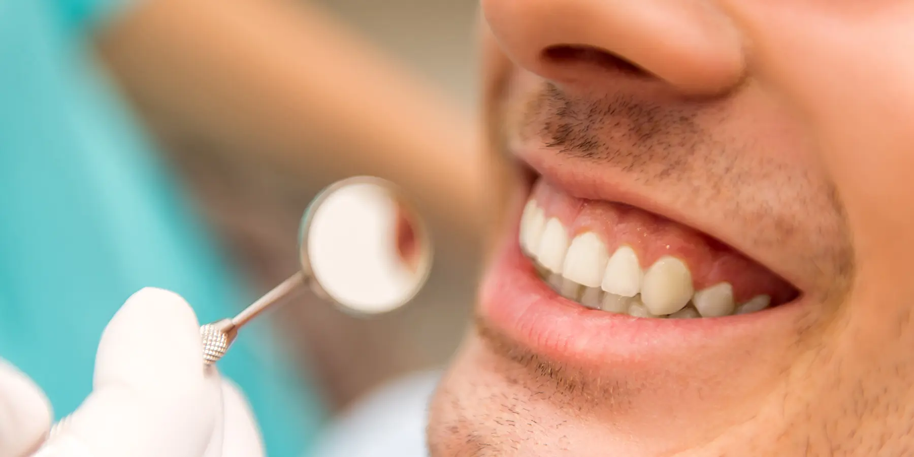 How Long Does Composite Bonding Last?