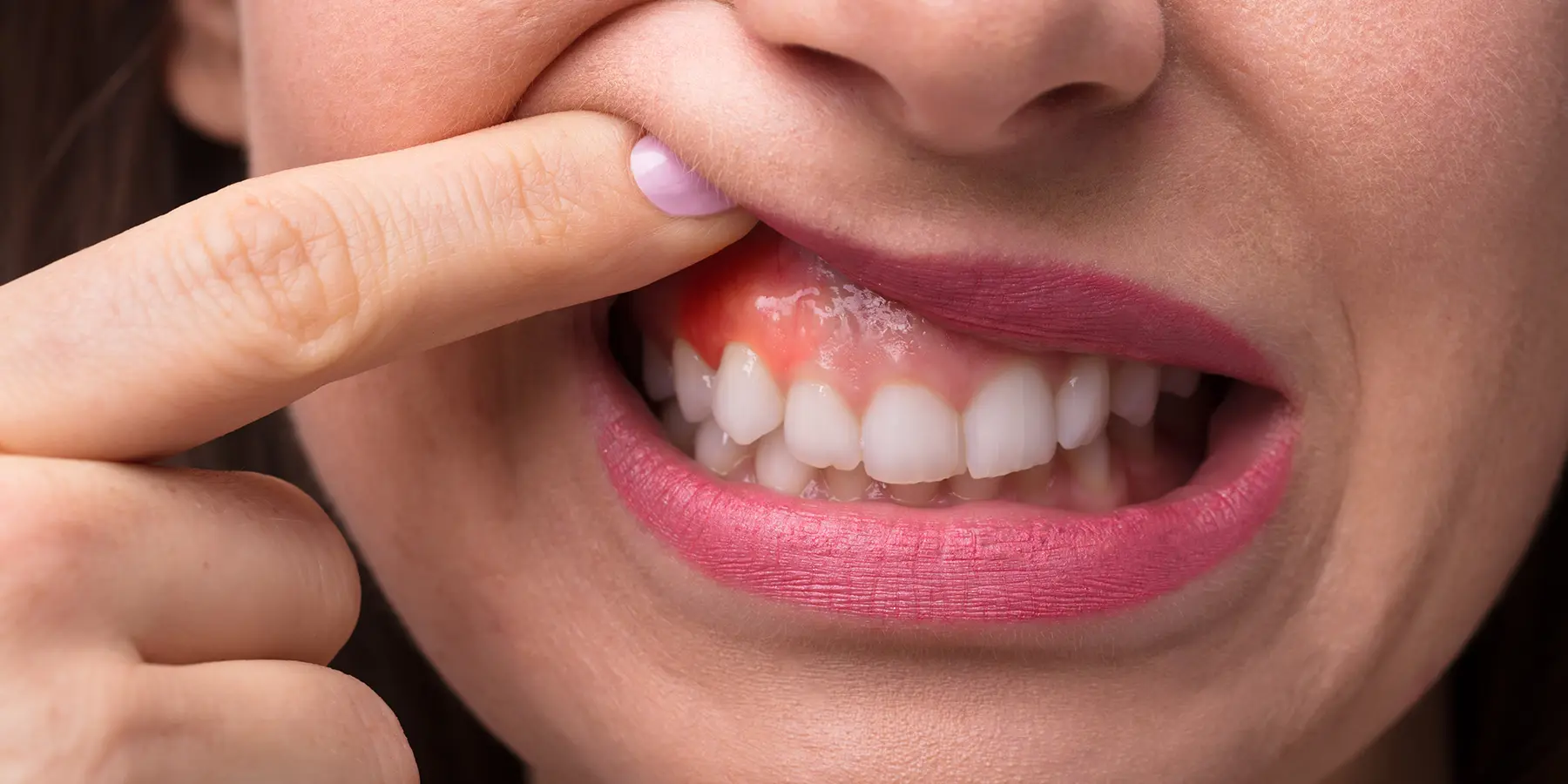 Why Are My Gums Swollen? 5 Reasons for Swollen Gums