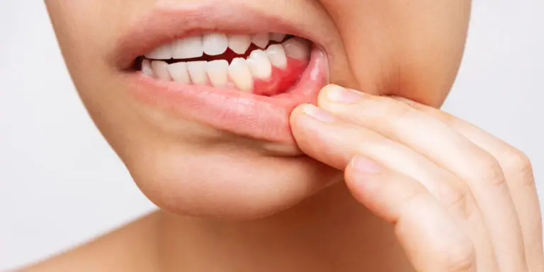 Veneers and Gum Disease: What’s Possible and What’s Not