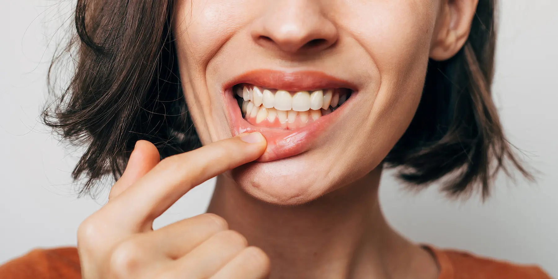 How Gum Health Affects Your Veneer Timeline
