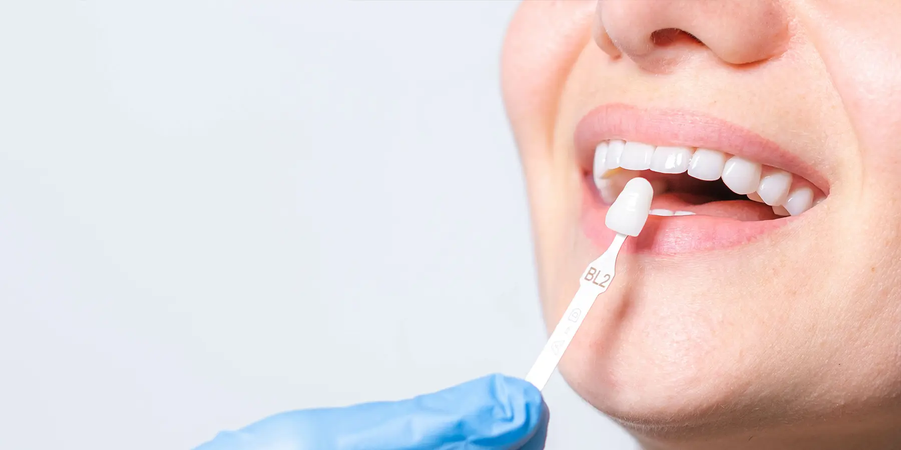 How Much Do Veneers Cost in Buffalo Grove, IL?