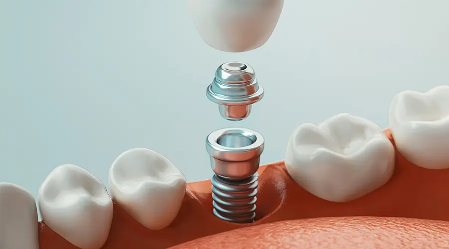 Prosthodontics in Buffalo Grove, IL