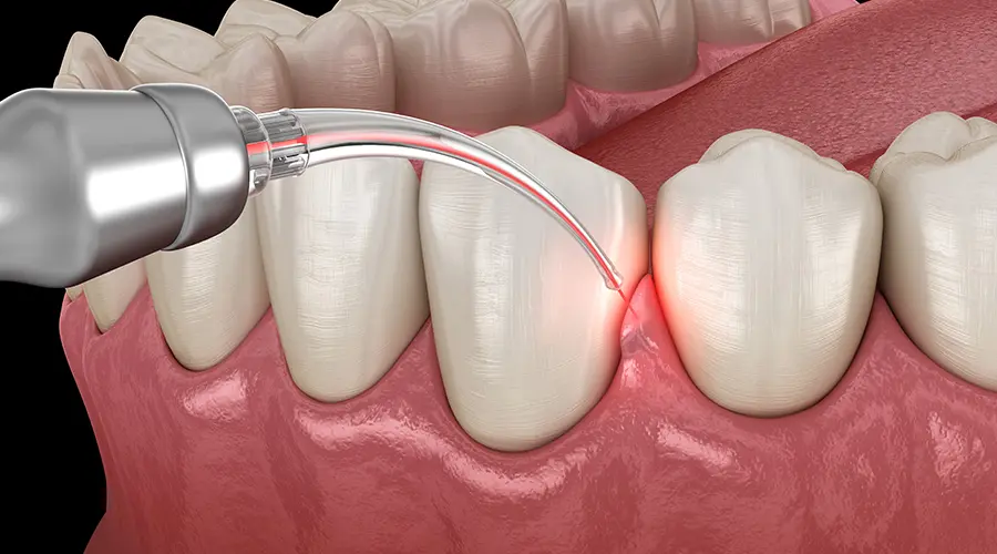 Laser Dentistry