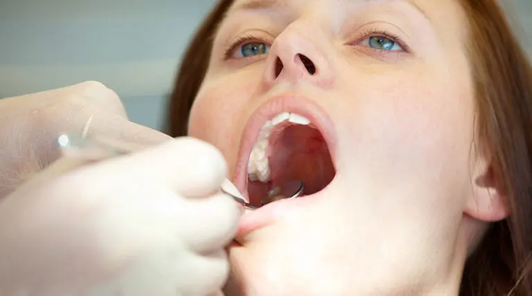 Can Dental Fillings Fall Out? What to Do If It Happens