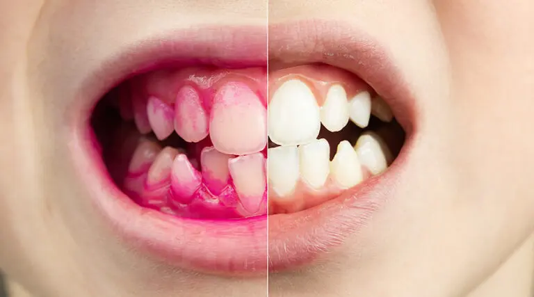Plaque Disclosing Tablets: What They Do and How To Use Them