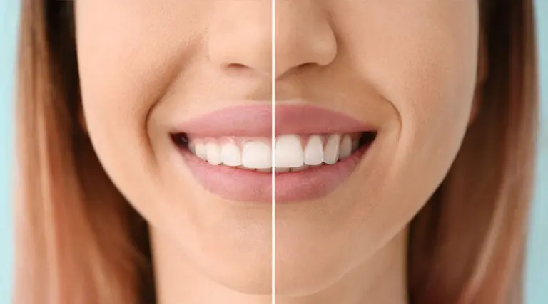 Laser Gum Contouring for a Gummy Smile