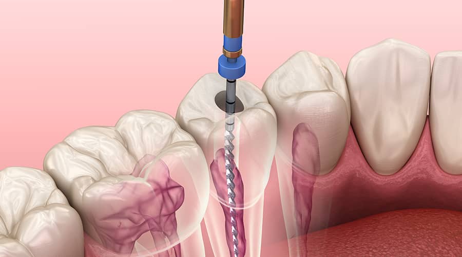 Root Canal Therapy